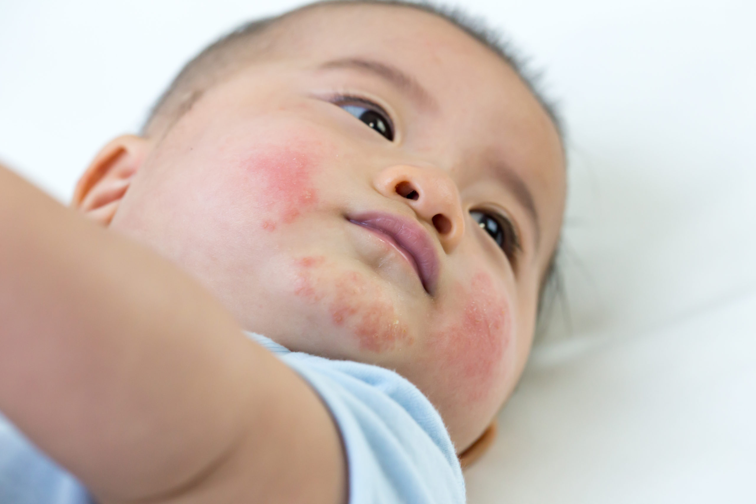 乳児湿疹 おおふな皮ふ科の皮膚科診察案内