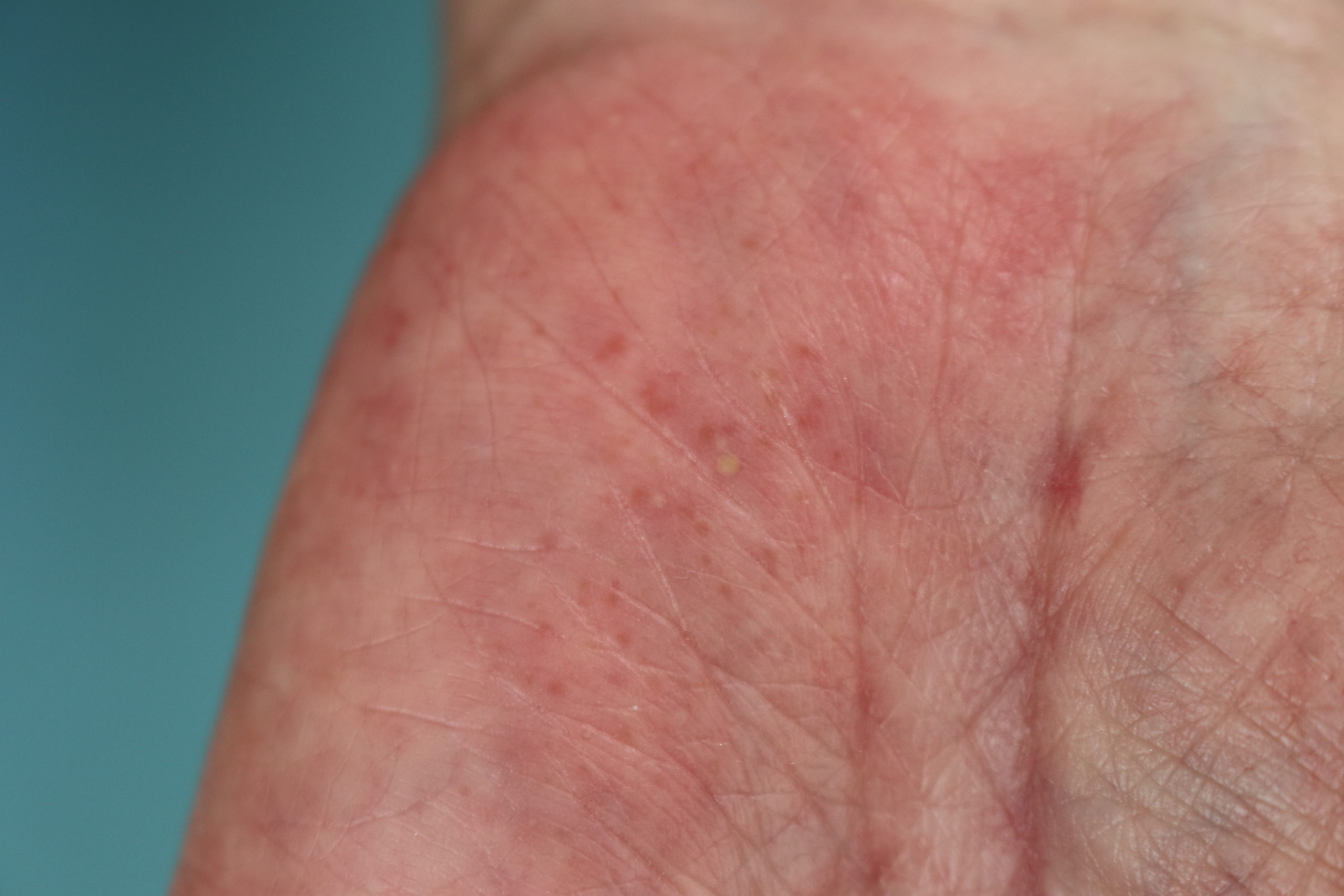 掌蹠膿疱症 しょうせきのうほうしょう おおふな皮ふ科の皮膚科診察案内